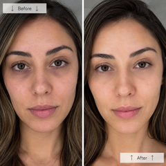 Risultato fototerapia LED — before after occhiaie e sguardo stanco