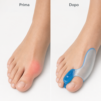 Prima e dopo comfort alluce con correttore in gel